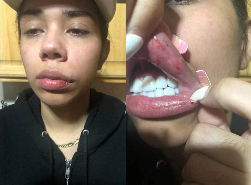 Сара Молина показала раны после избиения 6ix9ine​Фото: Instagram